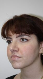 Rhinoplasty Patient 42 - After - 2 Thumbnail