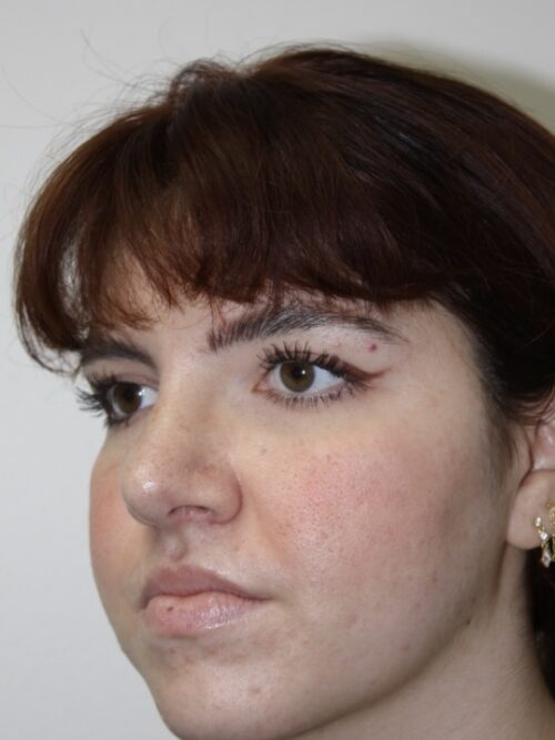 Rhinoplasty Patient 42 - After - 2