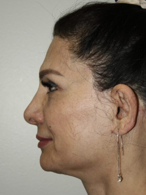 Female Facelift Patient 73 - After - 3