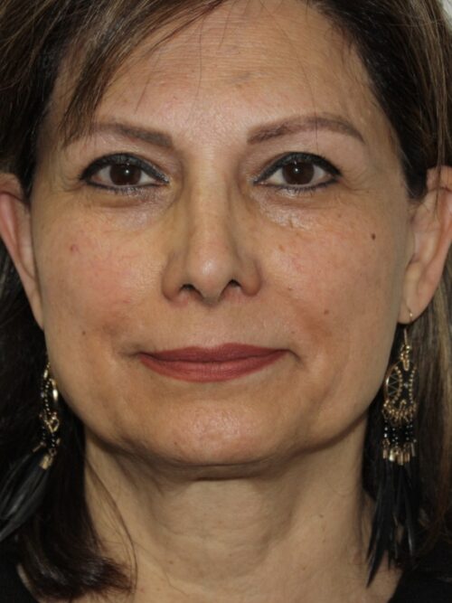 Female Facelift Patient 73 - Before - 2