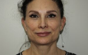 Female Facelift Patient 73 - After - 2 Thumbnail