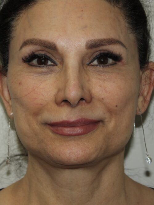 Female Facelift Patient 73 - After - 2