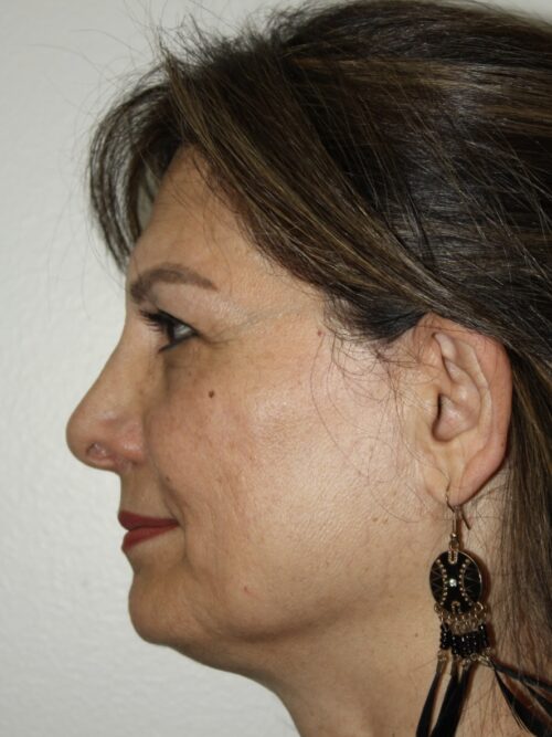 Female Facelift Patient 73 - Before - 3