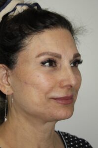 Female Facelift Patient 73 - After - 1 Thumbnail