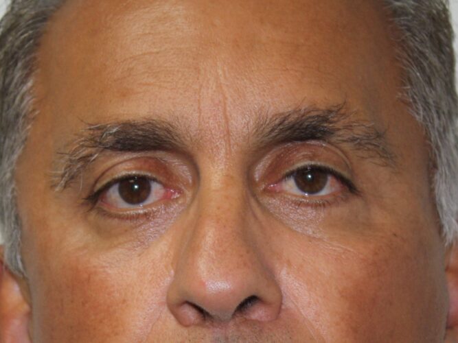 Eyes BK after