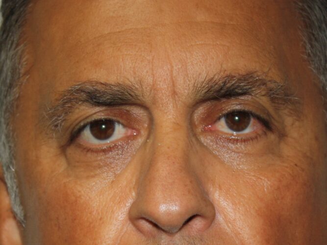 Eyes BK before