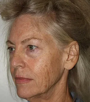 real patient results in Newport Beach, CA