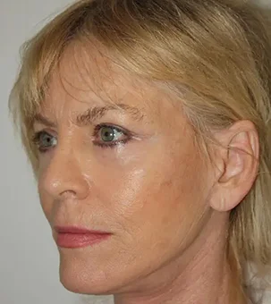 real patient results in Newport Beach, CA