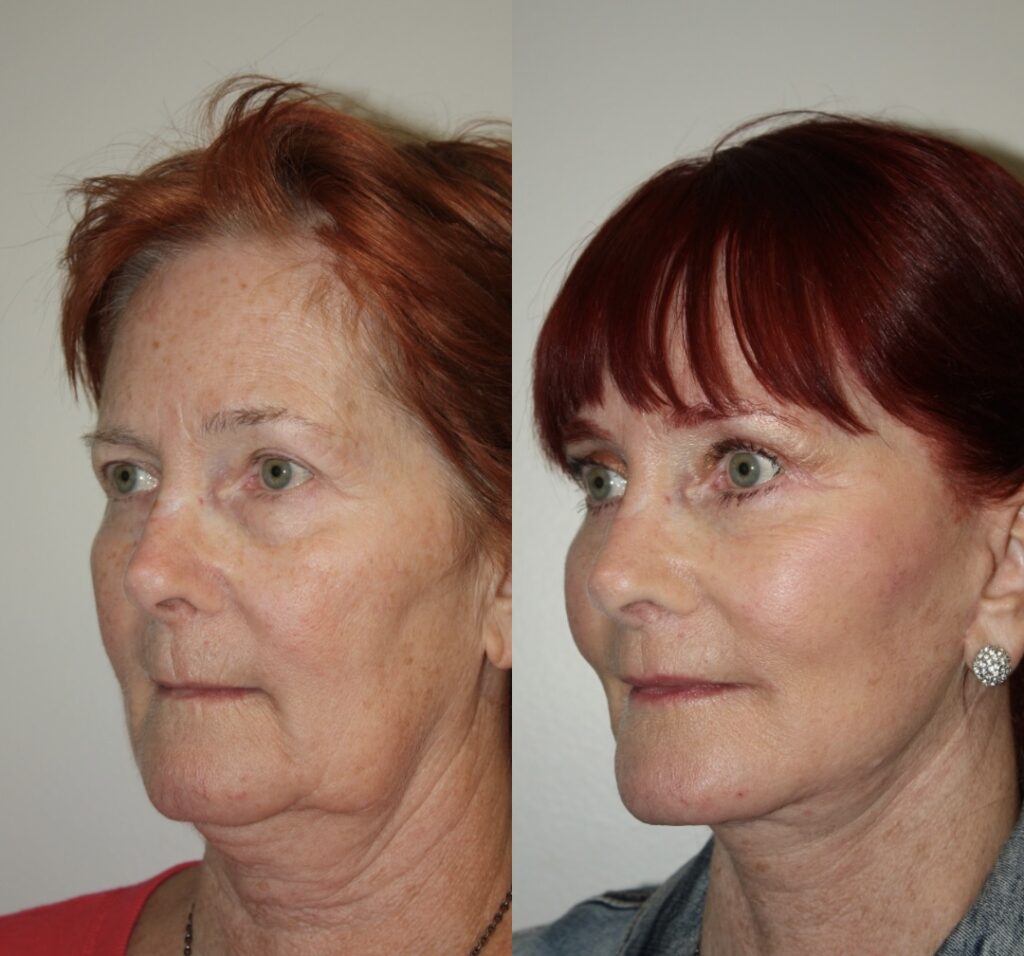 Actual patient results 1
