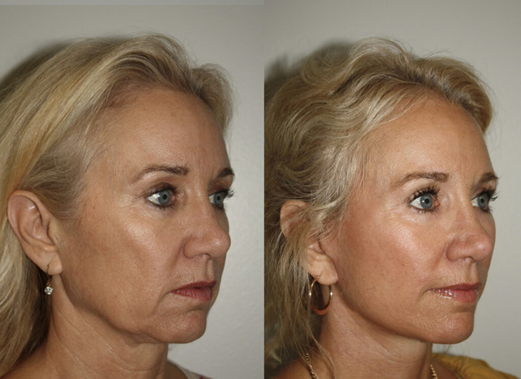 Actual patient results 3