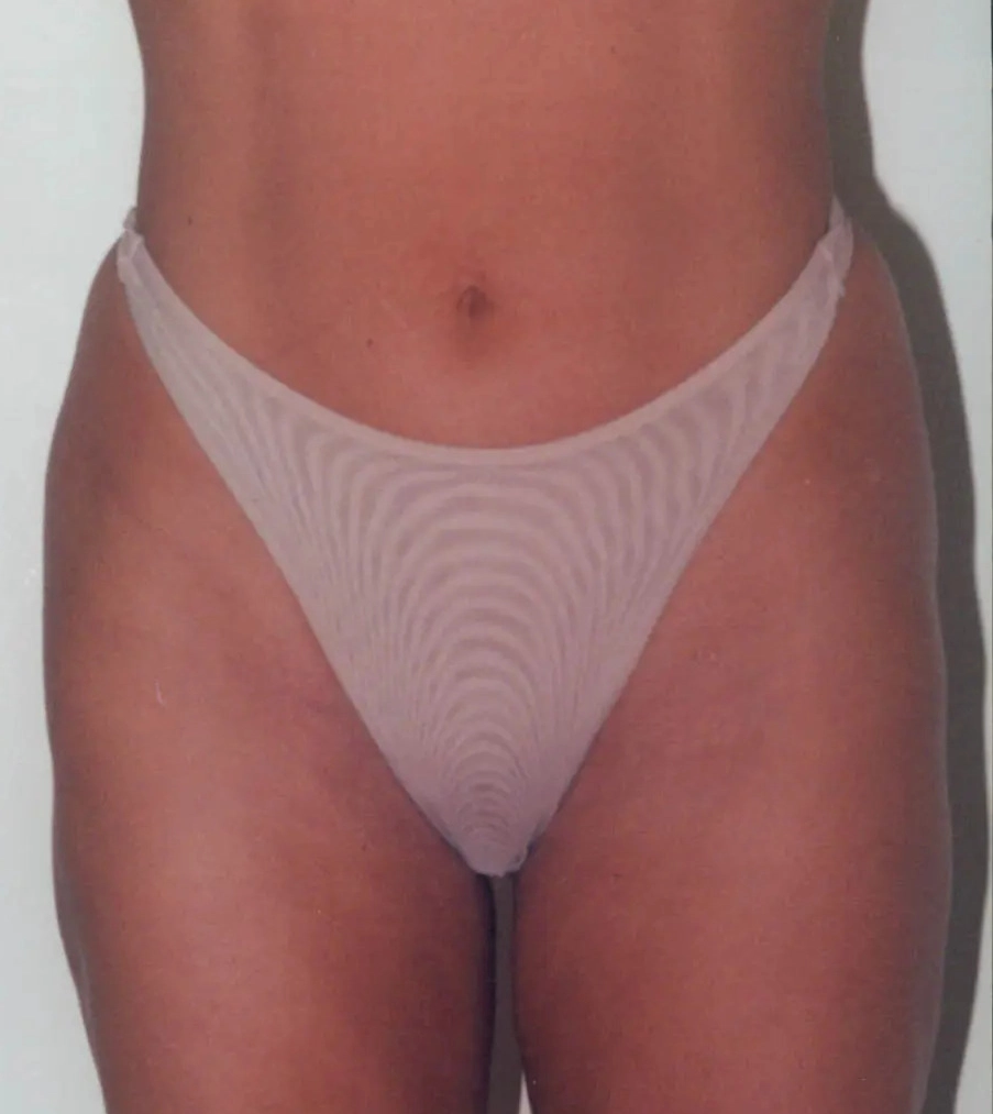 Real patient results in Newport Beach, CA Performed by Boris M. Ackerman MD