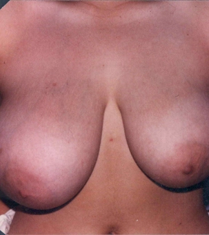 Real patient results in Newport Beach, CA Performed by Boris M. Ackerman MD