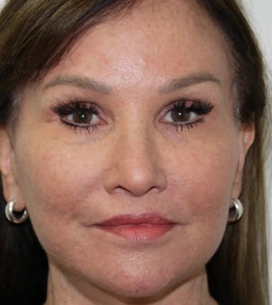 Real patient results in Newport Beach, CA Performed by Boris M. Ackerman MD
