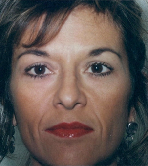 Real patient results in Newport Beach, CA Performed by Boris M. Ackerman MD