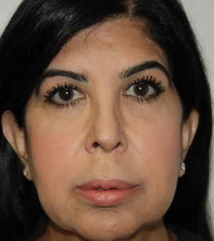 Real patient results in Newport Beach, CA Performed by Boris M. Ackerman MD