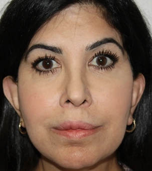 Real patient results in Newport Beach, CA Performed by Boris M. Ackerman MD
