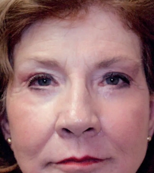 Real patient results in Newport Beach, CA Performed by Boris M. Ackerman MD