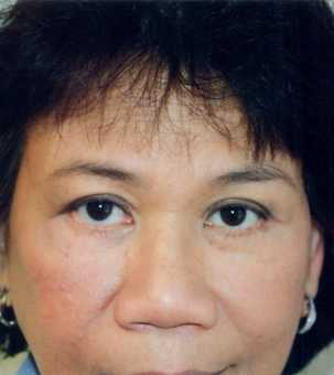 Real patient results in Newport Beach, CA Performed by Boris M. Ackerman MD