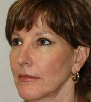 Real patient results in Newport Beach, CA Performed by Boris M. Ackerman MD