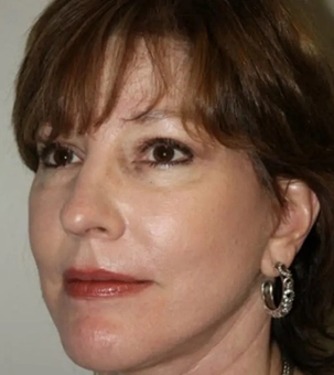 Real patient results in Newport Beach, CA Performed by Boris M. Ackerman MD