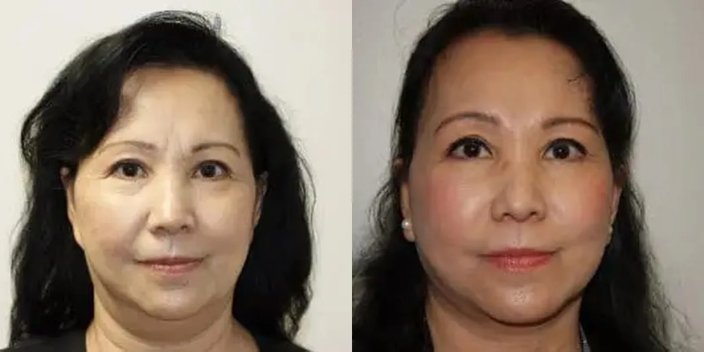 facelift_before_after_front_1000x500