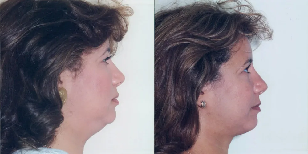 facelift_before_after_profile_1000x500