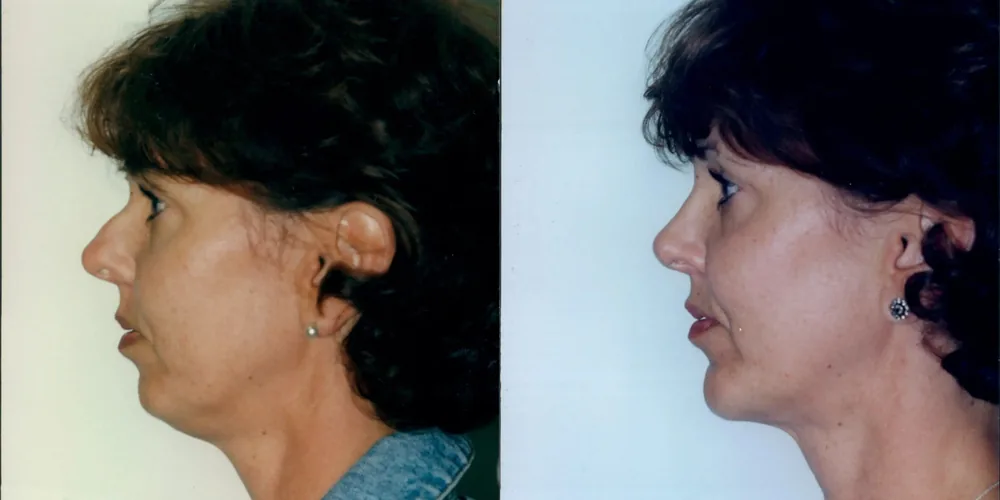 facelift_pair_3_1000x500