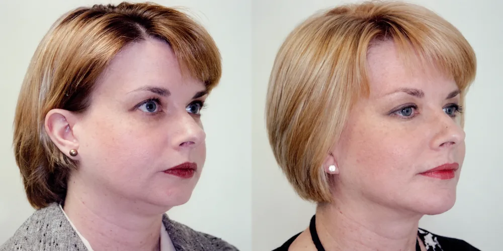 facelift_set_01_1000x500