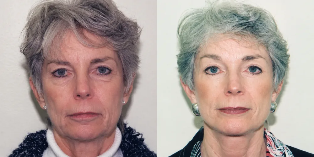 facelift_set_02_1000x500