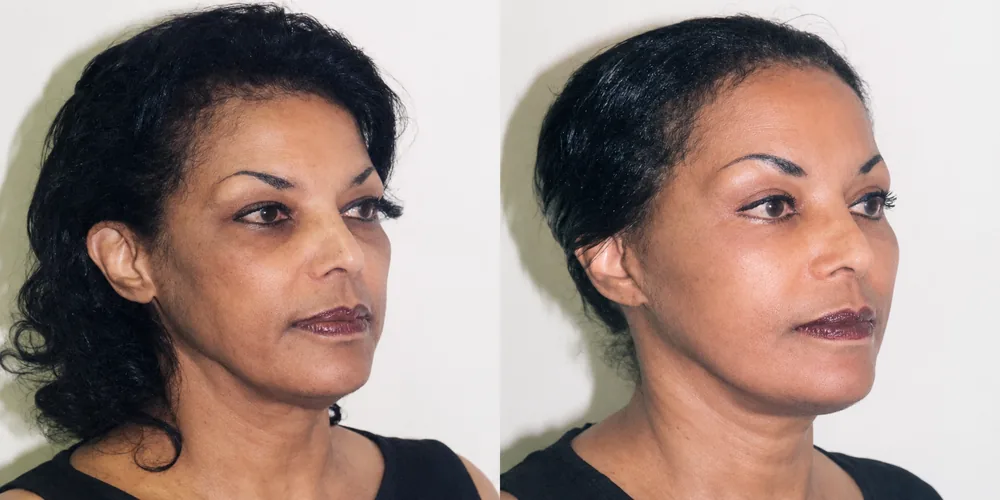 facelift_set_03_1000x500