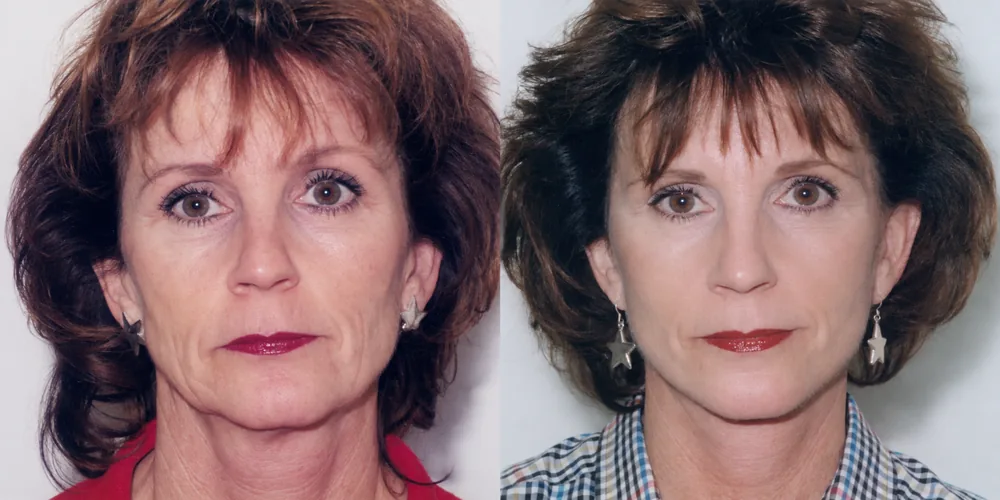 facelift_set_04_1000x500