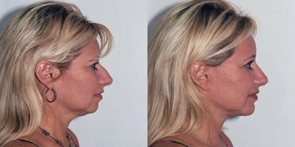 facelift_set_05_1000x500