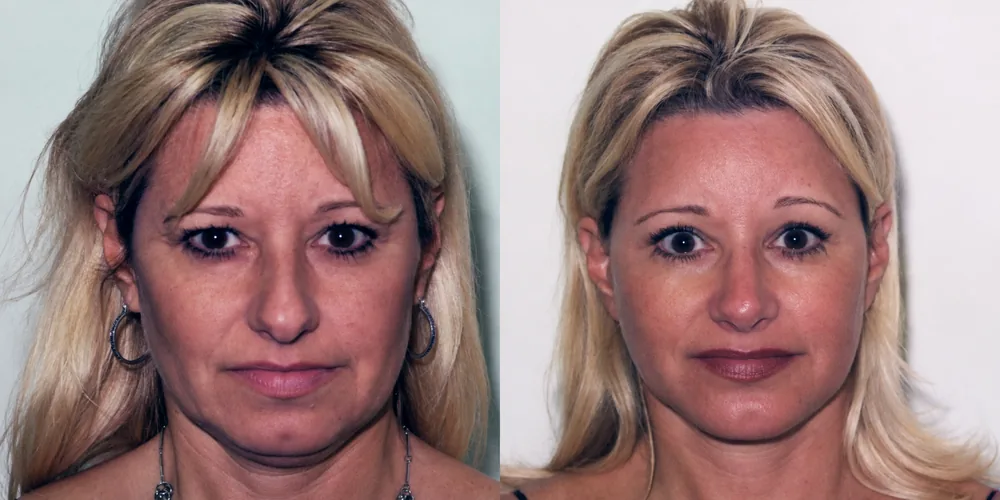 facelift_set_06_1000x500