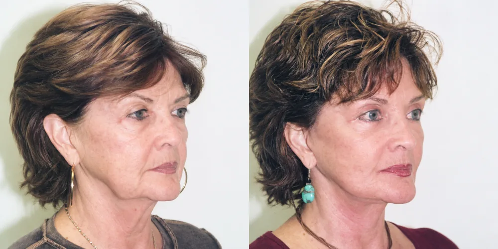 facelift_set_07_1000x500