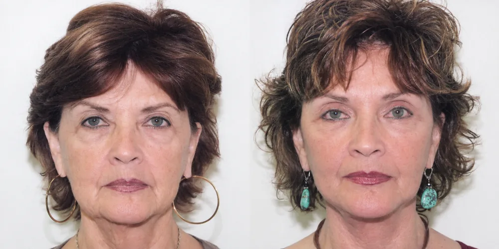 facelift_set_08_1000x500