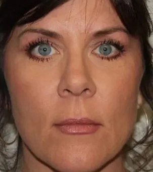 Real patient results in Newport Beach, CA Performed by Boris M. Ackerman MD