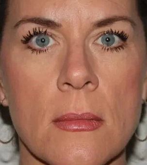 Real patient results in Newport Beach, CA Performed by Boris M. Ackerman MD