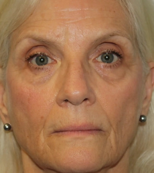 Real patient results in Newport Beach, CA Performed by Boris M. Ackerman MD