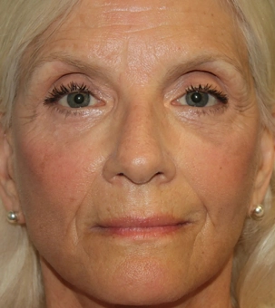 Real patient results in Newport Beach, CA Performed by Boris M. Ackerman MD