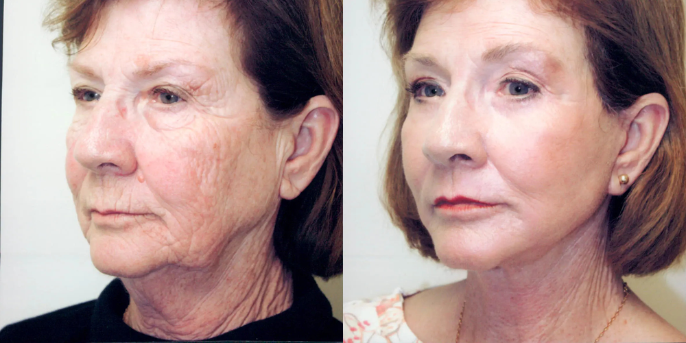 female-facelift1_000113-000214