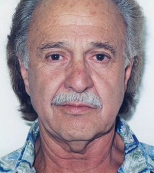 Real patient results in Newport Beach, CA Performed by Boris M. Ackerman MD