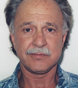 Real patient results in Newport Beach, CA Performed by Boris M. Ackerman MD