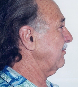Real patient results in Newport Beach, CA Performed by Boris M. Ackerman MD
