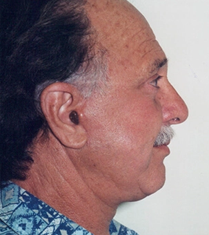 Real patient results in Newport Beach, CA Performed by Boris M. Ackerman MD