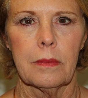 Real patient results in Newport Beach, CA Performed by Boris M. Ackerman MD