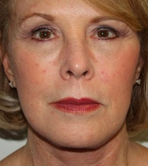 Real patient results in Newport Beach, CA Performed by Boris M. Ackerman MD