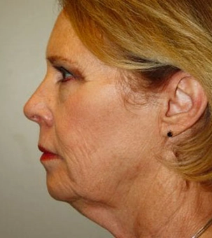 Real patient results in Newport Beach, CA Performed by Boris M. Ackerman MD