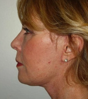 Real patient results in Newport Beach, CA Performed by Boris M. Ackerman MD