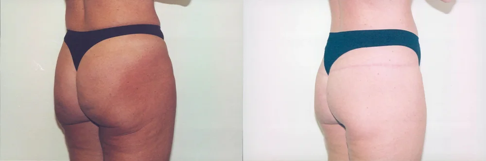 Real patient results in Newport Beach, CA Performed by Boris M. Ackerman MD
