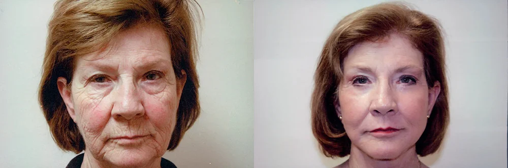 Real patient results in Newport Beach, CA Performed by Boris M. Ackerman MD